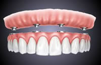 Attachment Dentures